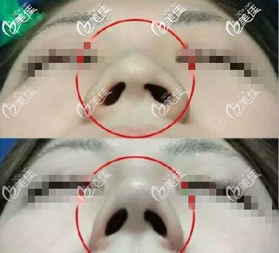 剛做完縮鼻翼三個月效果圖 剛做完縮鼻翼三個月效果圖