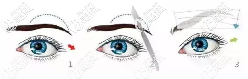 切眉術過程 切眉術過程
