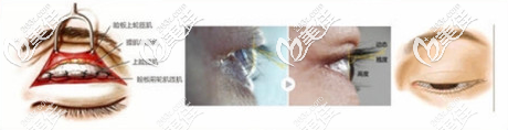 周洪超睫毛入路雙眼皮手術(shù)原理示意圖 周洪超睫毛入路雙眼皮手術(shù)原理示意圖