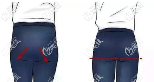 提臀線手術(shù)的位置 提臀線手術(shù)的位置