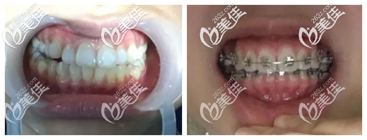 3M自鎖托槽前后對比圖 3M自鎖托槽前后對比圖