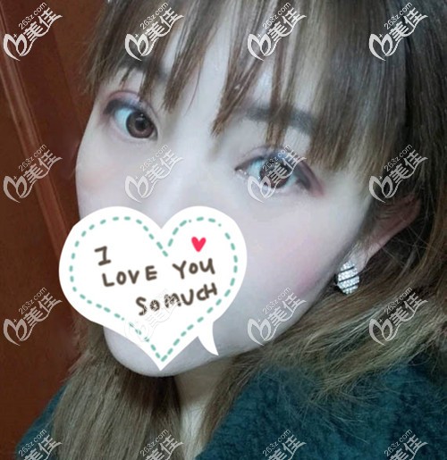 通過我的術(shù)后恢復(fù)效果圖,你能猜出我在宜賓正規(guī)整形醫(yī)院做的雙眼皮開眼角多少錢嗎？