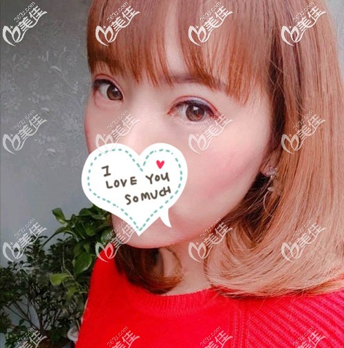 雙眼皮開眼角2個月效果就很自然了