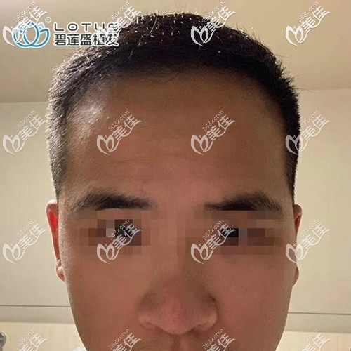 三級脫發(fā)需要多少毛囊多少錢?來看我做前額發(fā)際線植發(fā)1800單位效果圖，手術(shù)費(fèi)準(zhǔn)備2萬就夠了