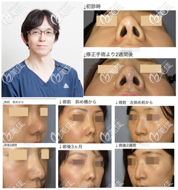 橫山才也醫(yī)生隆鼻修復(fù)案例