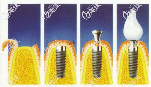 傳統(tǒng)種植牙過(guò)程