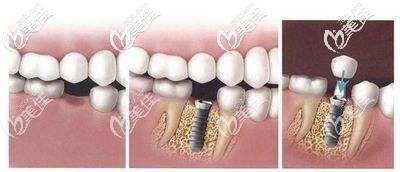 即刻種植牙過(guò)程