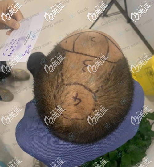 植發(fā)前設(shè)計(jì)了種植方案