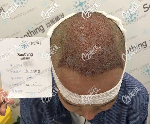 展示五級(jí)脫發(fā)大叔在頭頂加密植發(fā)四千單位效果圖!瞅瞅4000個(gè)毛囊能植發(fā)多大面積