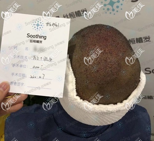 5級(jí)脫發(fā)植發(fā)4000單位即刻<span style=