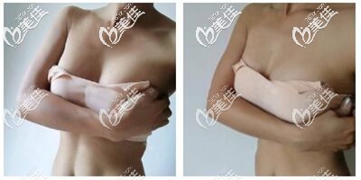 隆胸手術(shù)拆線后7天 隆胸手術(shù)拆線后7天