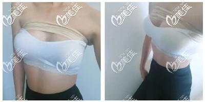 假體隆胸手術(shù)術(shù)后恢復(fù)1個月 假體隆胸手術(shù)術(shù)后恢復(fù)1個月