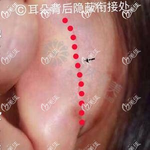 自體耳軟骨背面?。簭亩浔澈箅[蔽銜接處作切口取