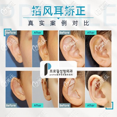 招風(fēng)耳前后對比案例