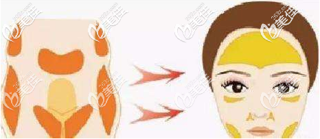 自體脂肪面部填充