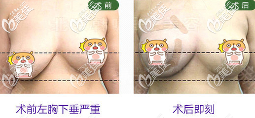 韓嘯醫(yī)生乳房上提術(shù)的案例
