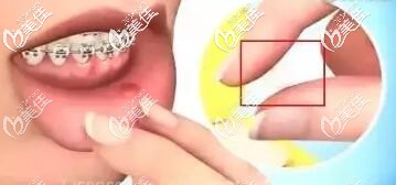 牙套導(dǎo)致口腔潰瘍 牙套導(dǎo)致口腔潰瘍