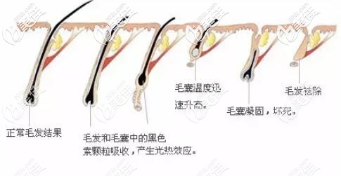 激光脫胡子過程原理圖