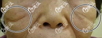 靜態(tài)印第安紋可以做埋線提升改善