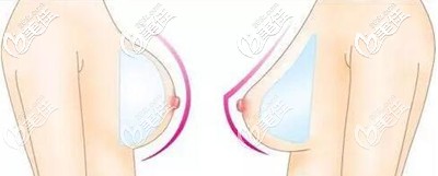 水滴形假體和圓形的區(qū)別