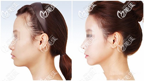 鼻綜合手術(shù)前后對比案例 鼻綜合手術(shù)前后對比案例