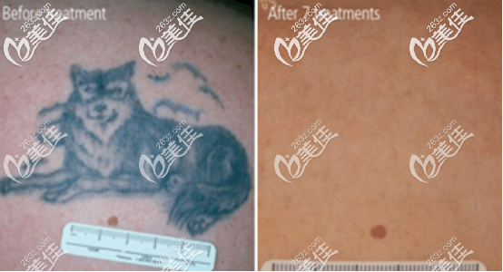 調Q紅寶石的祛紋身圖 調Q紅寶石的祛紋身圖