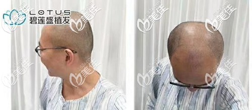 植發(fā)術(shù)前照片，剃光了頭發(fā)