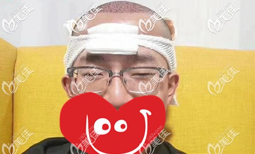 剛做完植發(fā)手術(shù)后的效果