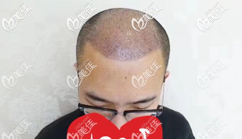 術(shù)后第五天清理了頭部血痂