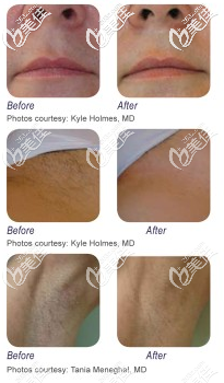 華爾茲冰點脫毛 華爾茲冰點脫毛