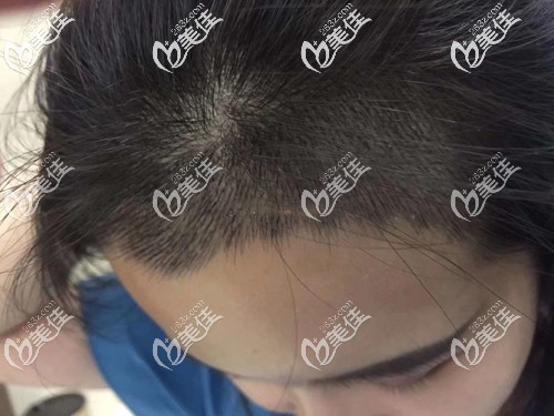 女士發(fā)際線種植2000單位效果圖