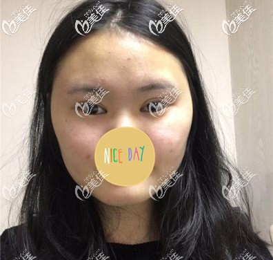 面部吸脂術(shù)前正面照片 面部吸脂術(shù)前正面照片