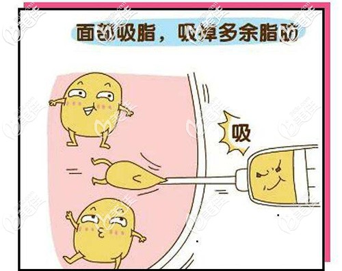 面部吸脂原理示意圖 面部吸脂原理示意圖