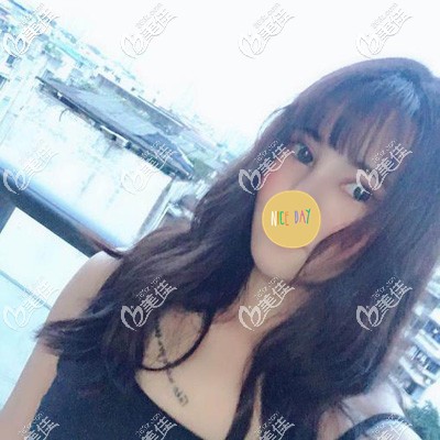 臉上脂肪多不但臉大雙下巴都出來了！輕松瘦臉我選擇AIS面部吸脂