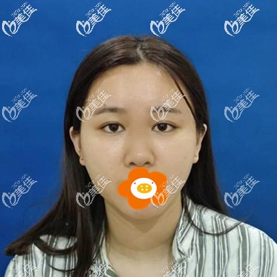 做鼻綜合手術前我的樣子 做鼻綜合手術前我的樣子