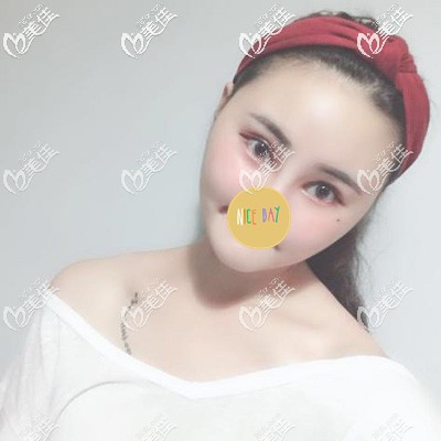 成都艾米麗潘紅偉ais面部吸脂技術(shù)效果 成都艾米麗潘紅偉ais面部吸脂技術(shù)效果