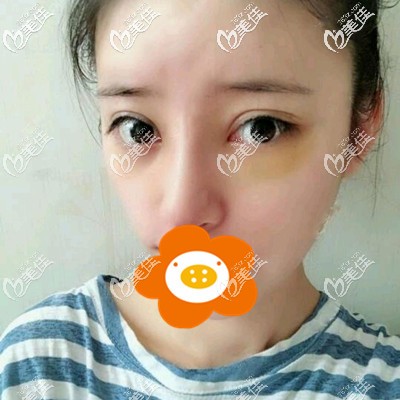 術后一周拆線還有點腫 術后一周拆線還有點腫