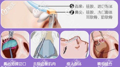 何靜醫(yī)生擅長做GMR美鼻術 何靜醫(yī)生擅長做GMR美鼻術