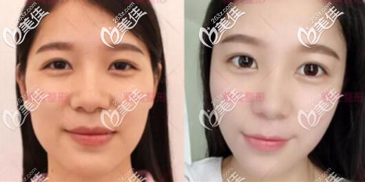 衡陽雅美面部微整形真人前后對比效果照片