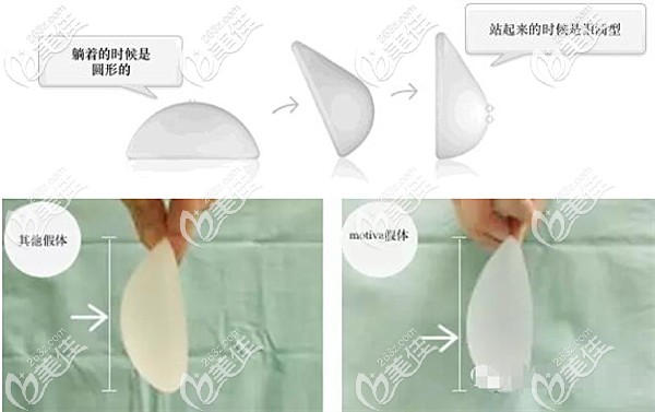 motiva隆胸假體優(yōu)勢