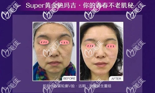 黃金熱瑪吉面部治療療效圖 黃金熱瑪吉面部治療療效圖