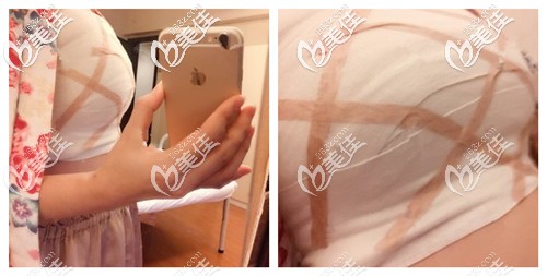 剛做完自體脂肪豐胸手術(shù)胸部變大 剛做完自體脂肪豐胸手術(shù)胸部變大