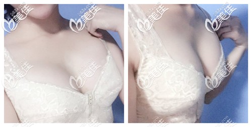 自體脂肪豐胸術(shù)后1個月胸部微腫脹 自體脂肪豐胸術(shù)后1個月胸部微腫脹