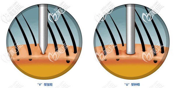 lattic加密種植技術(shù) 優(yōu)勢(shì)