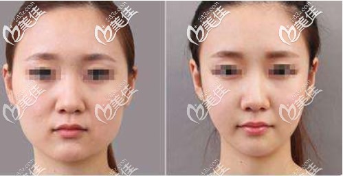 面部吸脂六個(gè)月后恢復(fù)效果