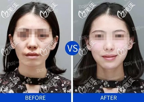 豐下巴前后對比案例