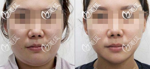 雙下巴吸脂前后對比照片 雙下巴吸脂前后對比照片