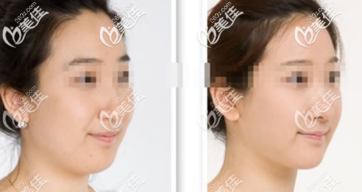 雙下巴吸脂效果怎么樣 雙下巴吸脂效果怎么樣