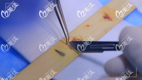 手術(shù)精細(xì)毛囊細(xì)微分離