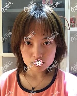 術(shù)前的我 術(shù)前的我